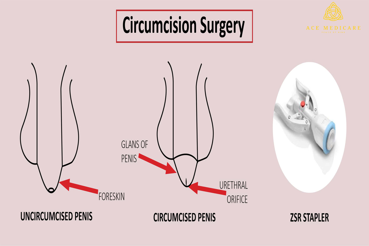 Circumcision vs. Khatna: Understanding the Differences and Controversies